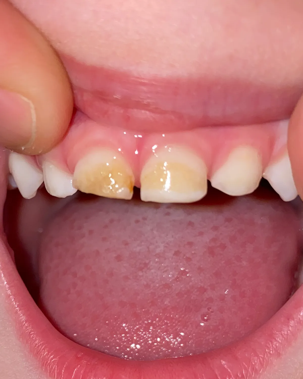 Close-up of his teeth eleven months into the remineralization protocol