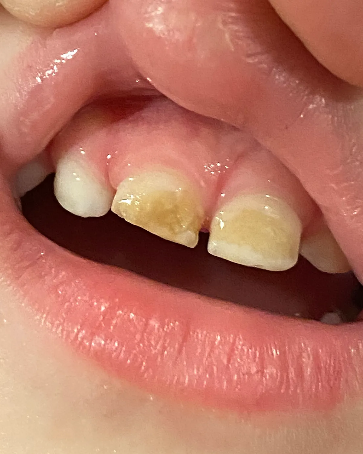 Close-up of his teeth thirteen months into the remineralization protocol
