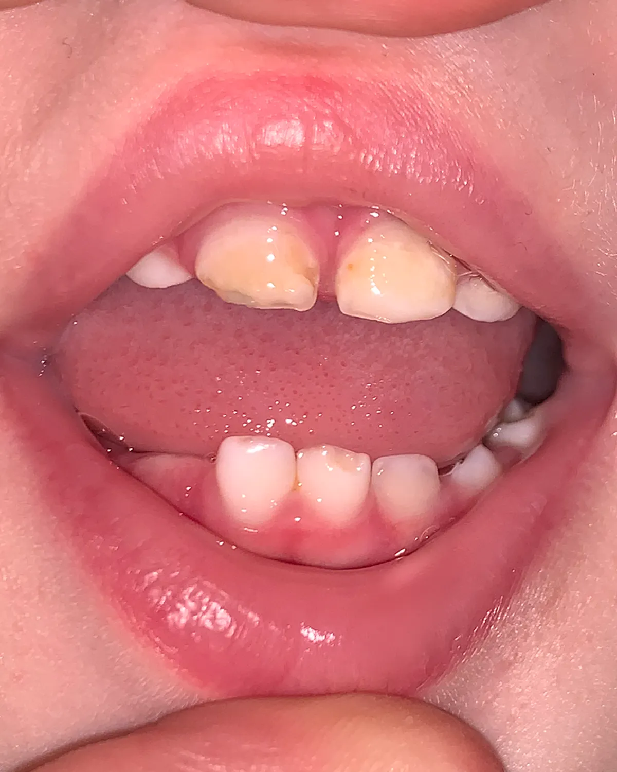 Close-up of his teeth three months into the remineralization protocol