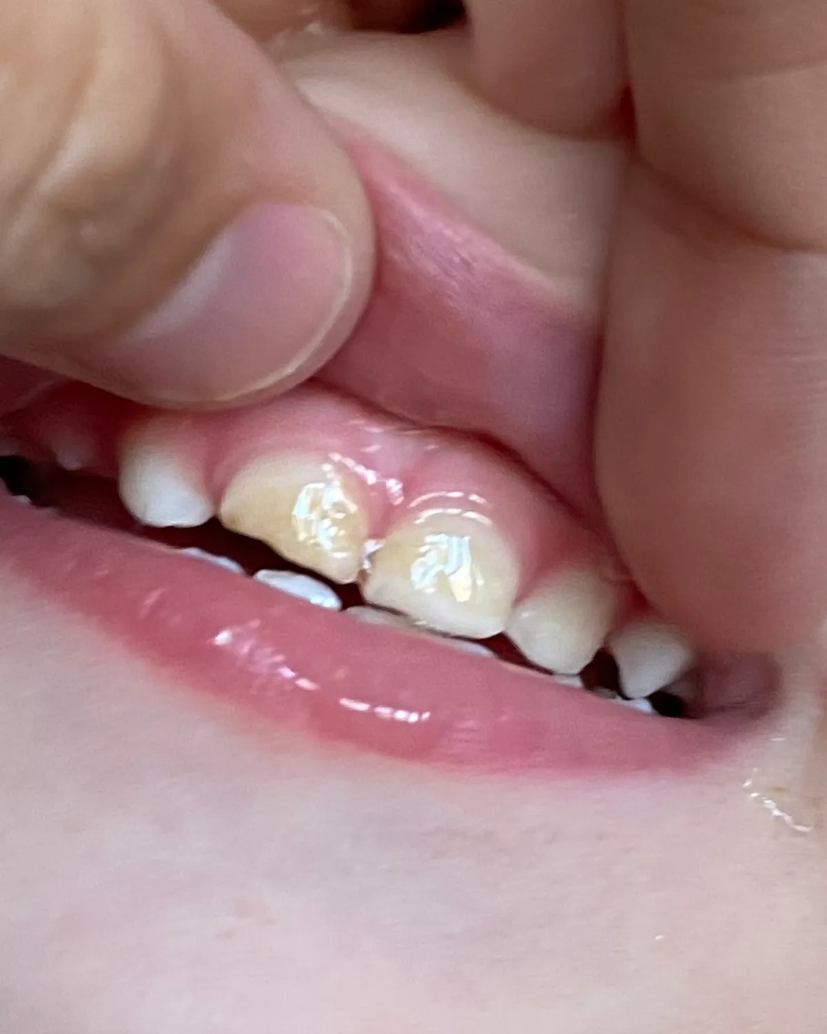 Close-up of his teeth six months into the remineralization protocol