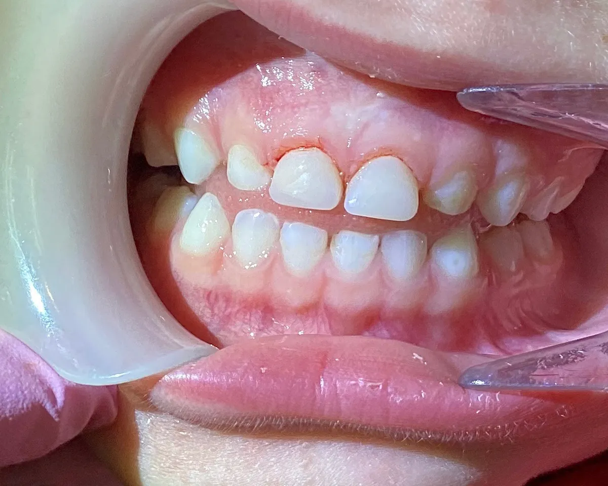 His teeth immediately after the restorative resin procedure, with the surface smoothed and color evened out