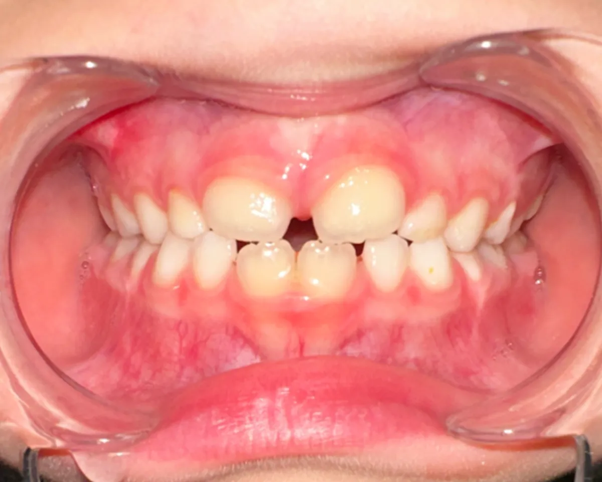 Our son nine months into the Toothpillow program to correct his jaw and airway