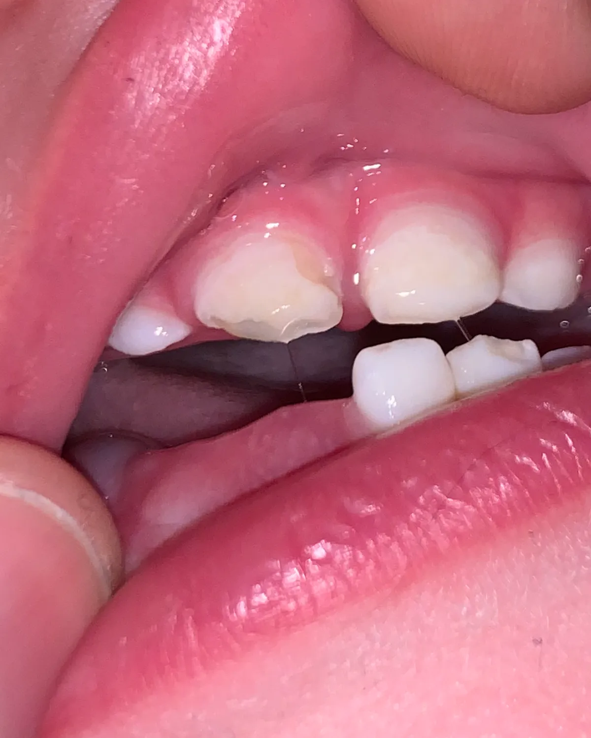 Close-up of his teeth before starting the remineralization protocol
