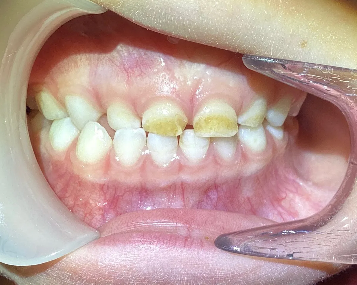 His teeth just before the restorative resin procedure, hard and healed but uneven in color and surface texture