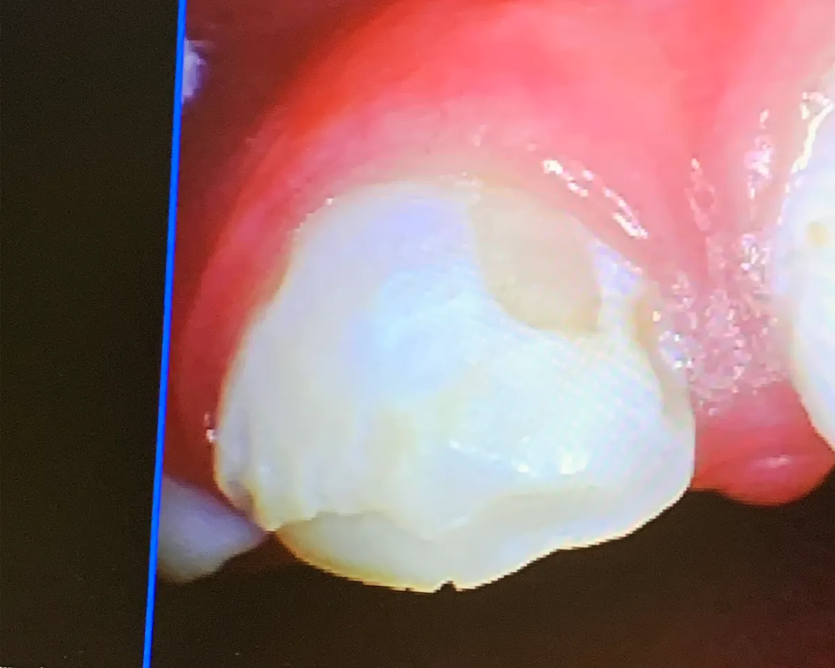 Intraoral camera close-up of his front teeth showing missing enamel and exposed dentin