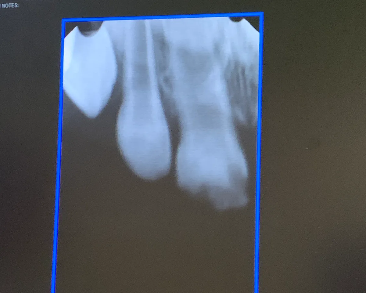X-ray imaging from the same visit confirming the extent of the enamel defect