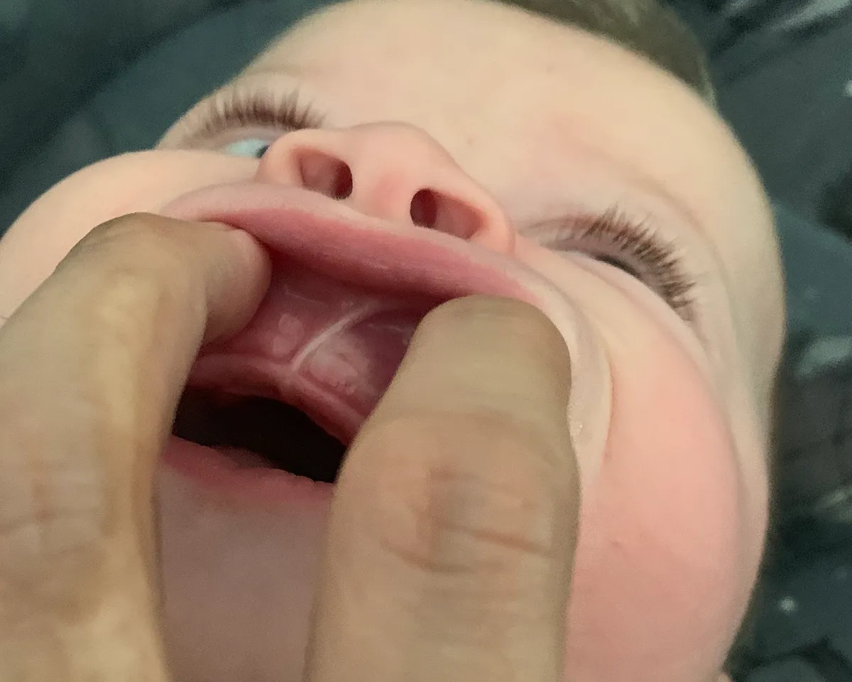 A child's upper lip lifted to show a restrictive lip tie attachment