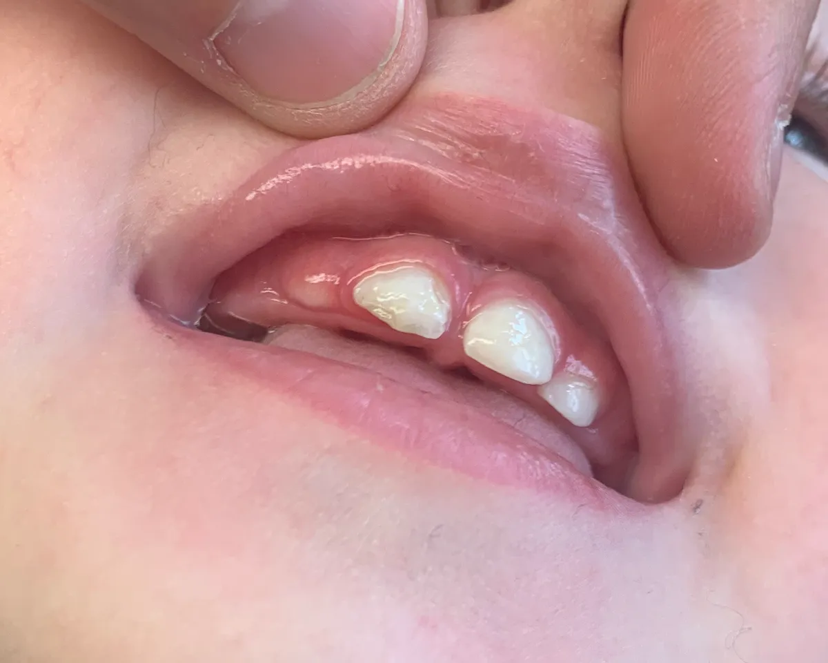 Close-up of his front teeth after the frenectomy, showing visibly worsened chipping and discoloration