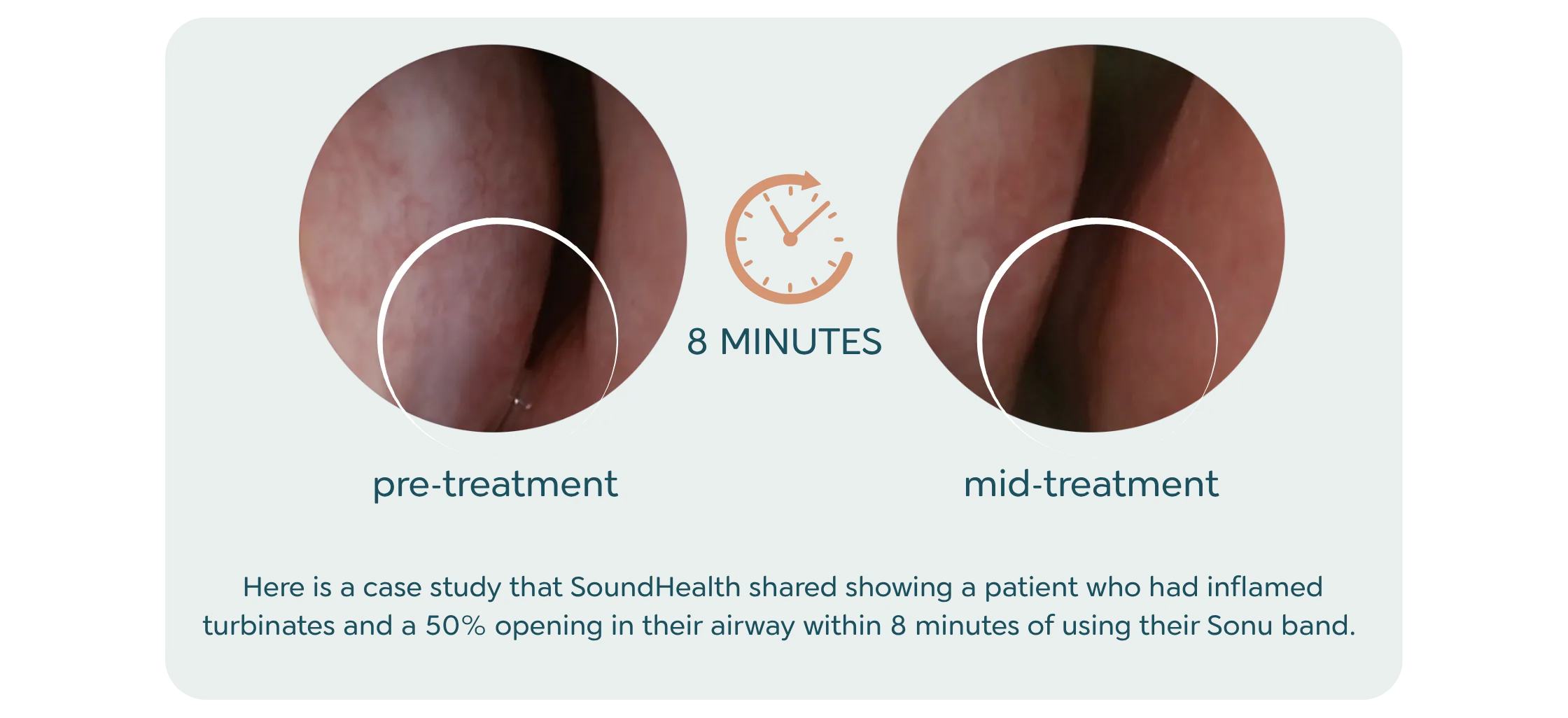 A SoundHealth case study showing pre-treatment and mid-treatment turbinate imaging at the 8-minute mark of a SONU Band session
