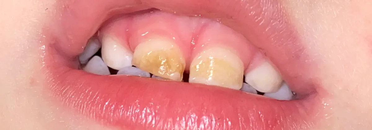 Close-up of his baby teeth mid-healing. Visible progress, but he still had more work to do from here.