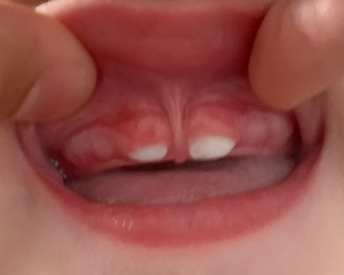 Close-up of baby teeth showing the chalky, translucent patches and uneven texture of enamel hypoplasia