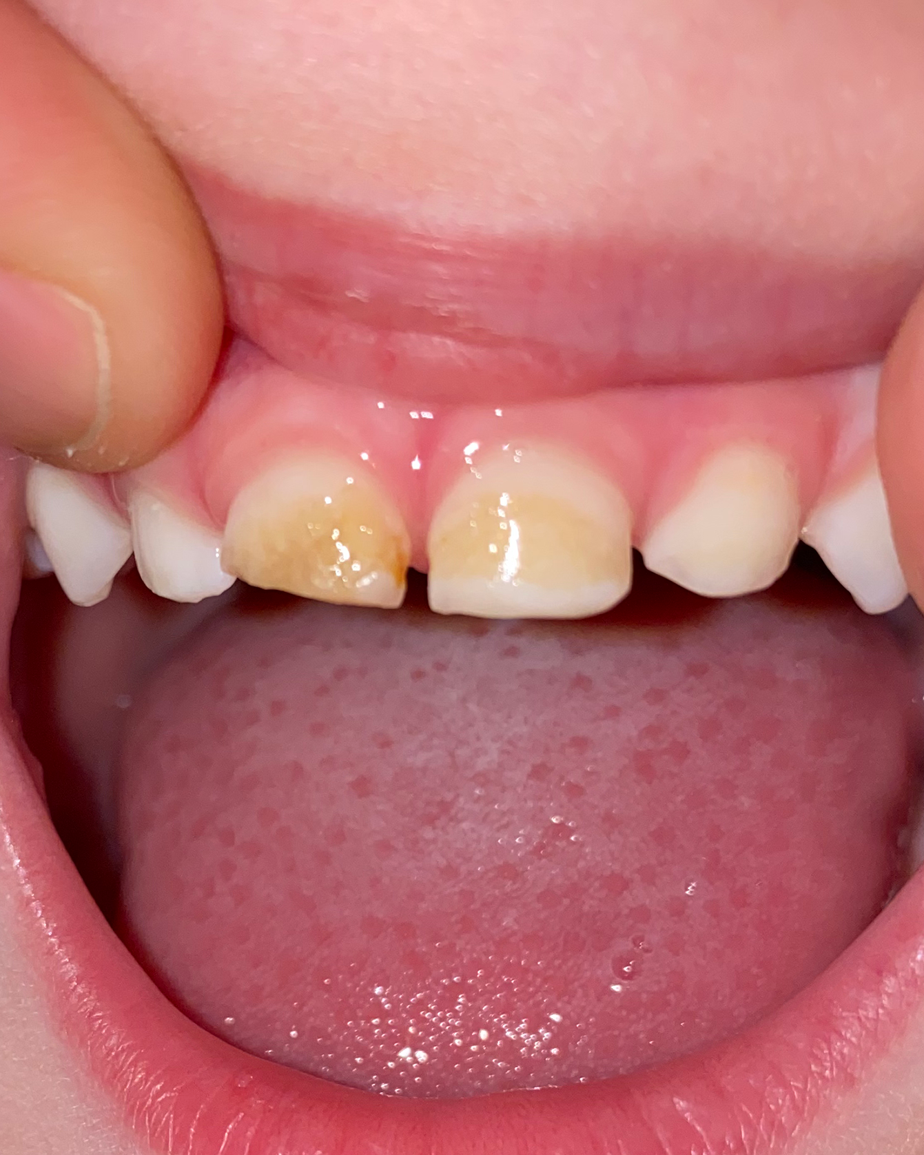 Close-up of his teeth eleven months into the remineralization protocol