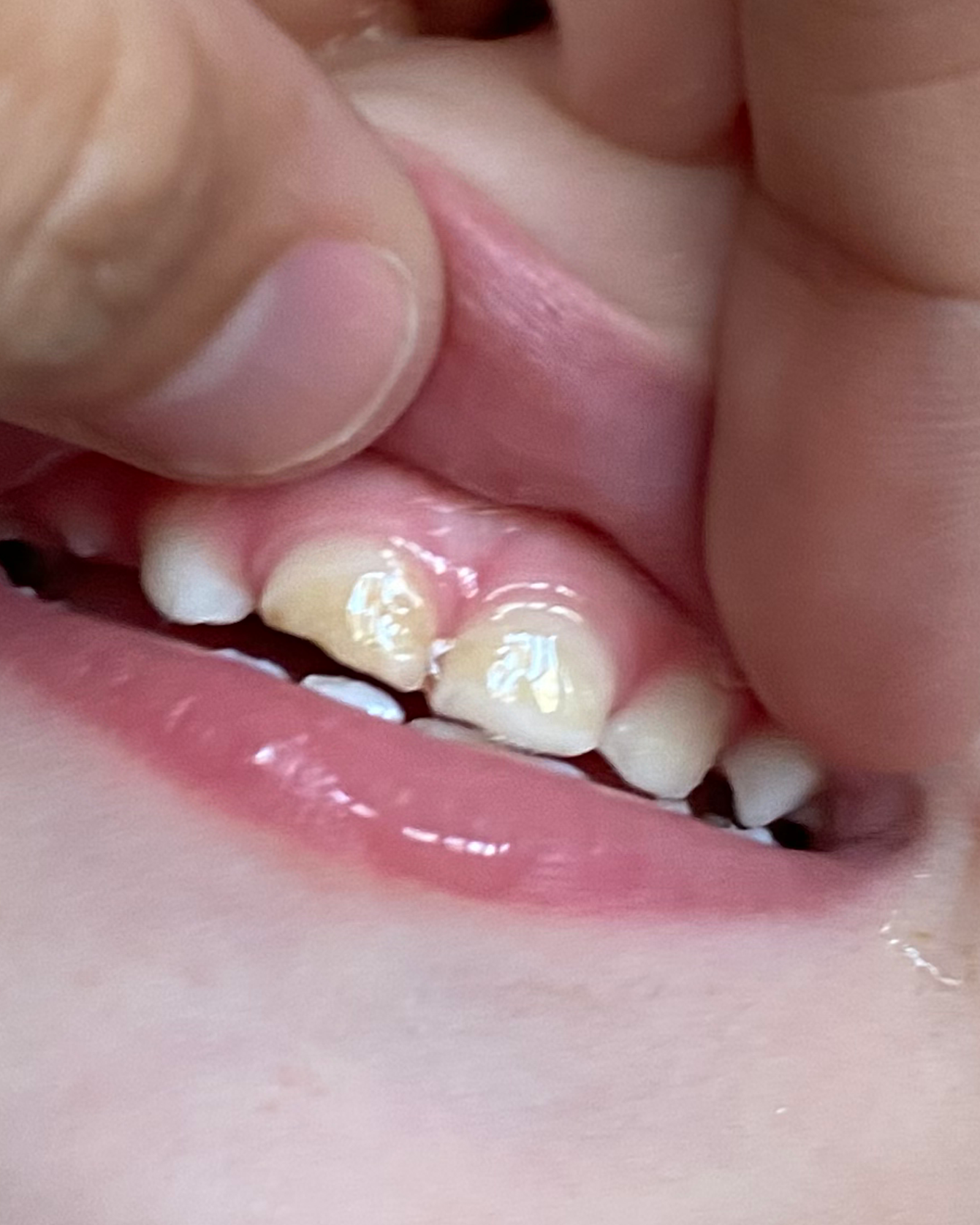 Close-up of his teeth six months into the remineralization protocol