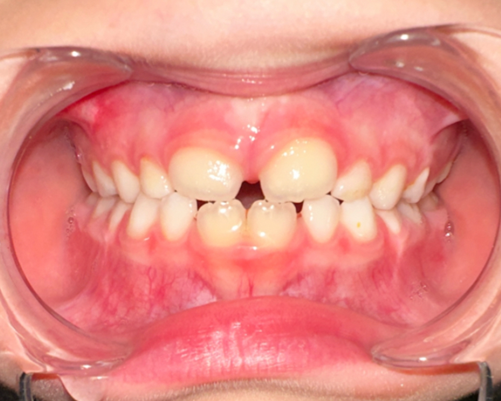 Our son nine months into the Toothpillow program to correct his jaw and airway