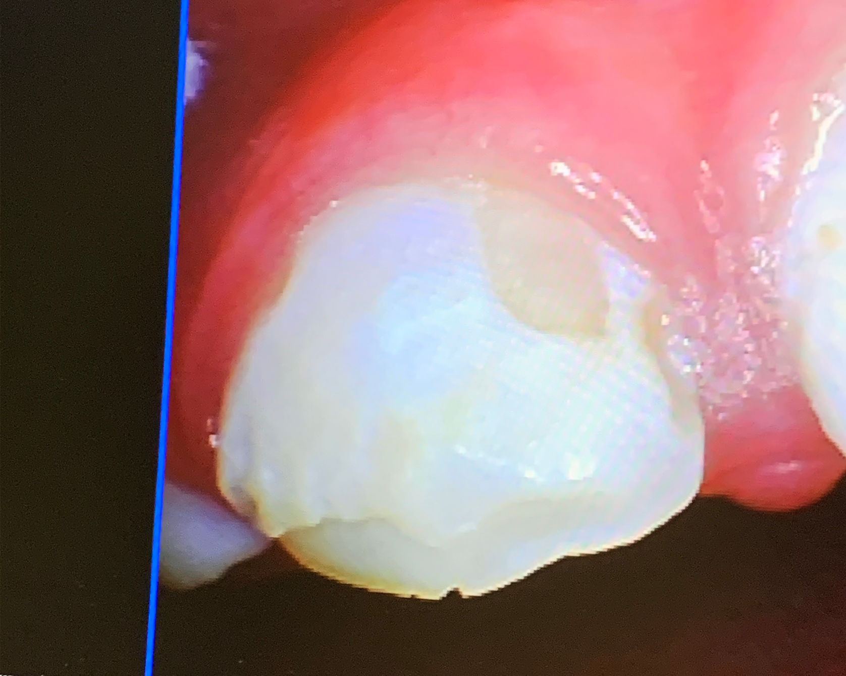 Intraoral camera close-up of his front teeth showing missing enamel and exposed dentin
