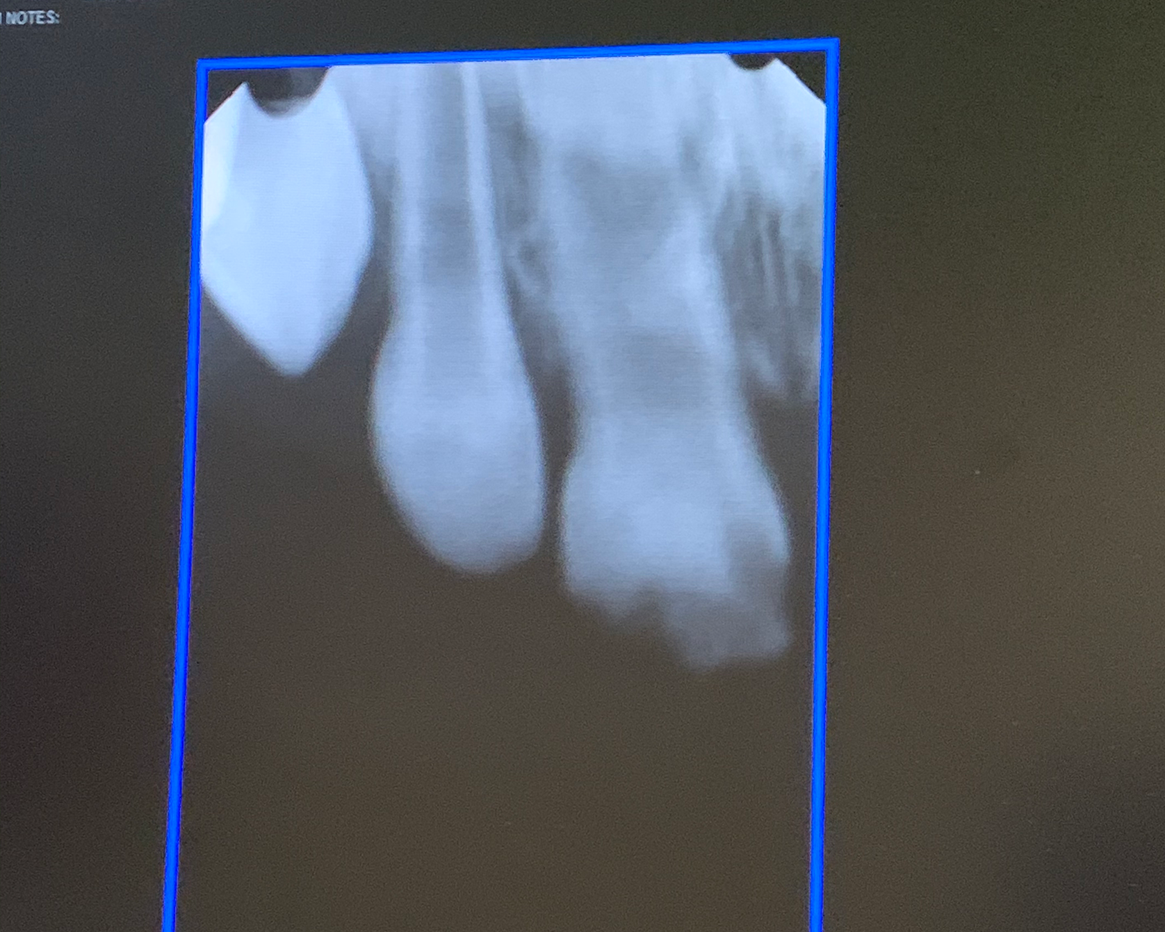 X-ray imaging from the same visit confirming the extent of the enamel defect