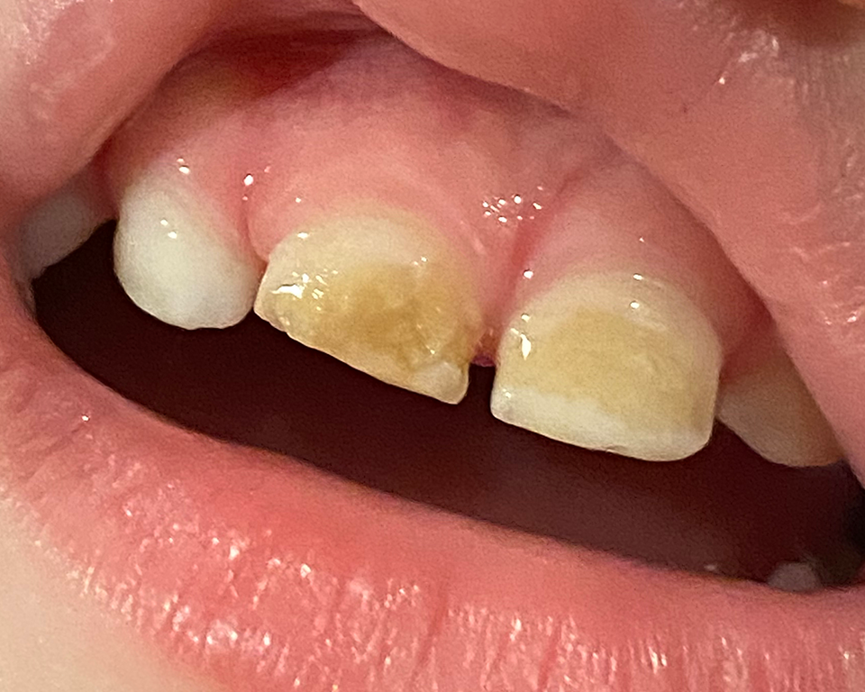 Close-up of his baby teeth mid-healing. Visible progress, but he still had more work to do from here.