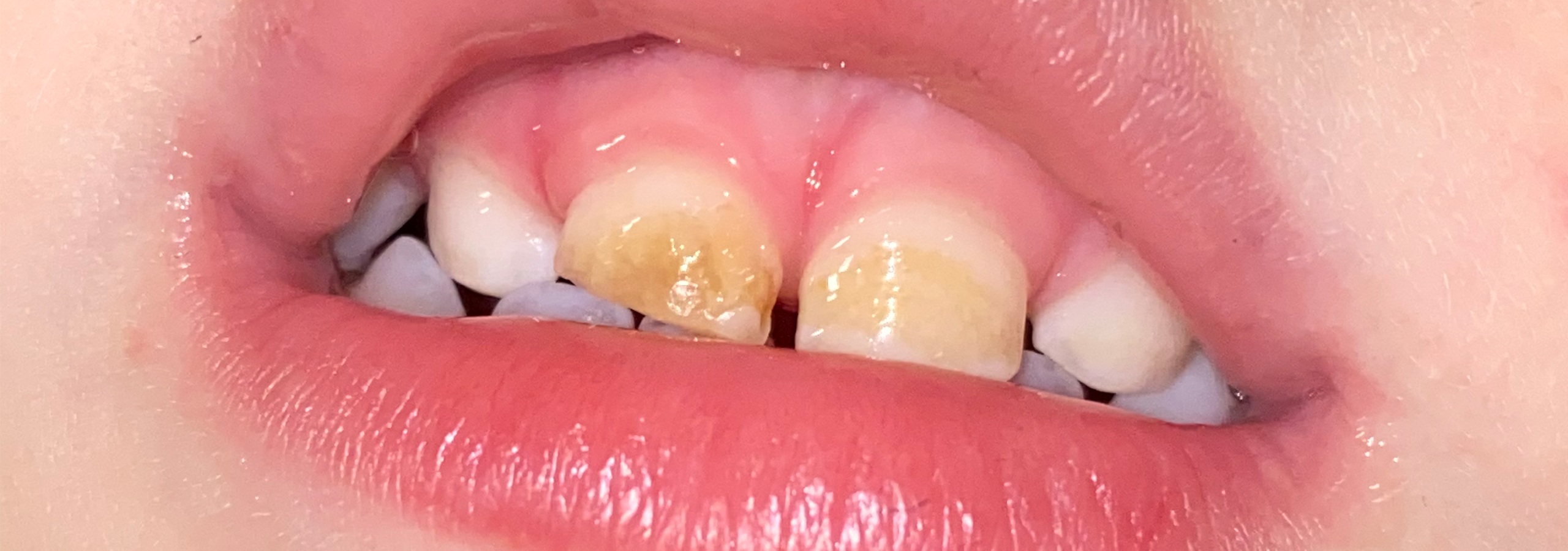 Close-up of his baby teeth mid-healing. Visible progress, but he still had more work to do from here.