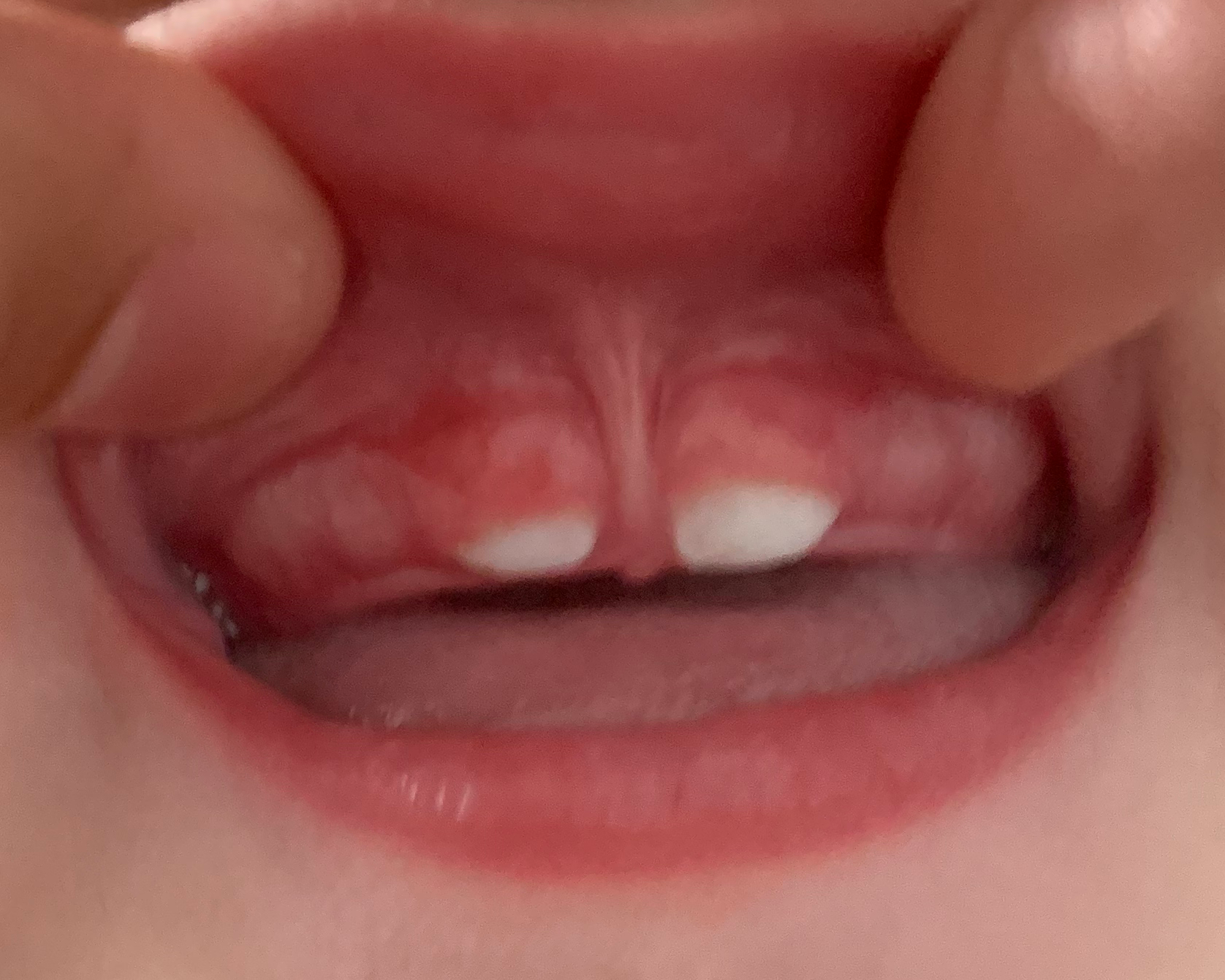 Close-up of baby teeth showing the chalky, translucent patches and uneven texture of enamel hypoplasia