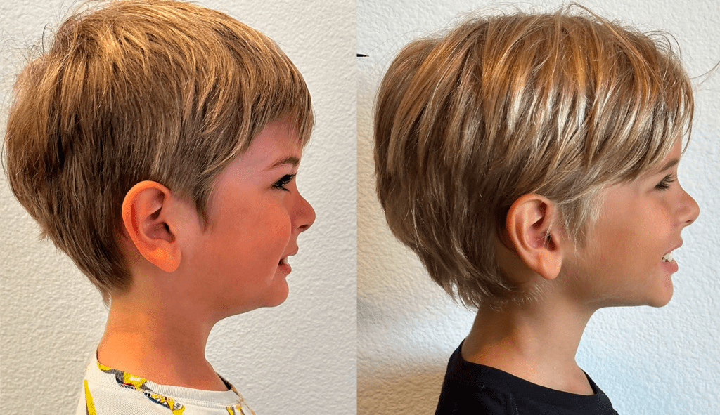 Side-by-side profile photos of our son showing the change in his jaw and facial development