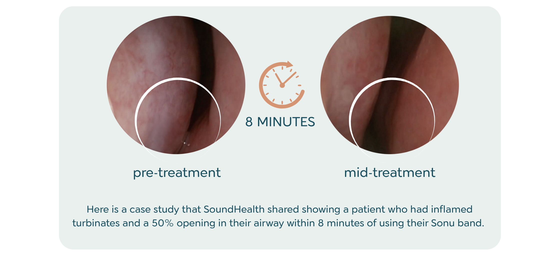 A SoundHealth case study showing pre-treatment and mid-treatment turbinate imaging at the 8-minute mark of a SONU Band session